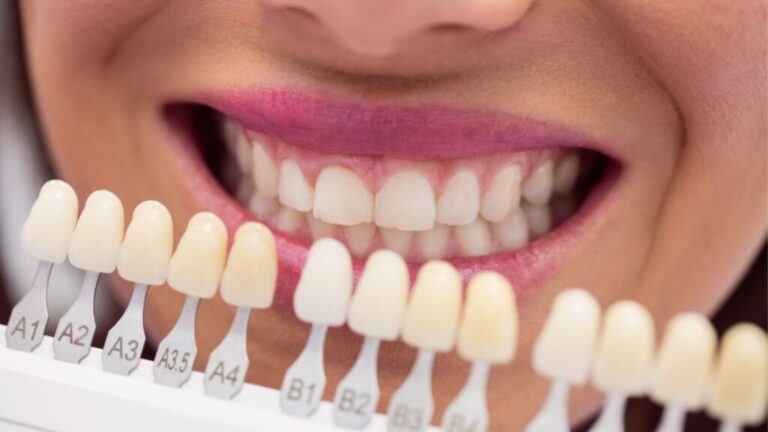 Dental Issues Veneers Address