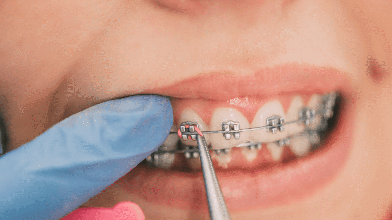 Understanding the Different Stages of Orthodontic Treatment Orthodontic Treatment