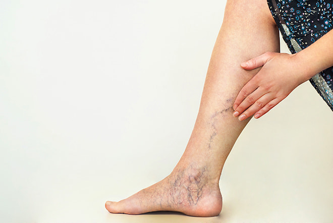 What Are Varicose Veins and Why Do They Appear? Varicose Veins