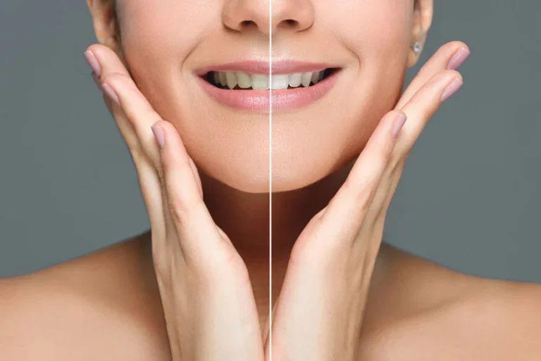 At-home vs. Professional Teeth Whitening