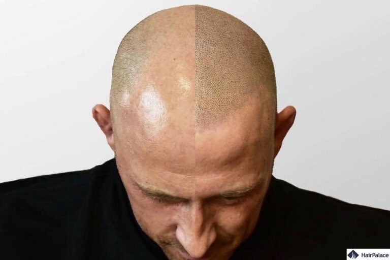 Hair Tattoos vs. Traditional Hairpieces